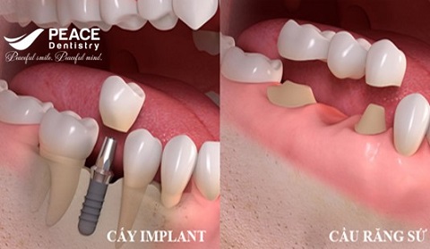 trồng răng implant có nguy hiểm không