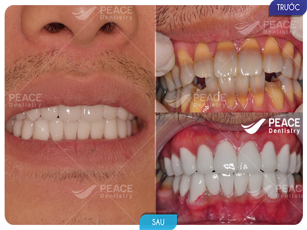 hình ảnh khách hàng bọc răng sứ 2