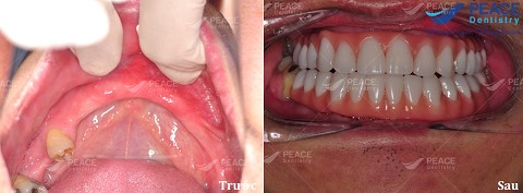 răng giả nguyên hàm tháo lắp