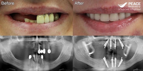 trồng răng implant ngăn ngừa tiêu xương