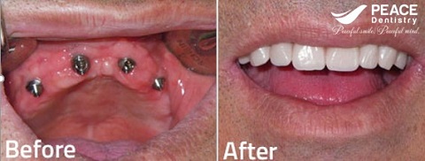 trồng răng implant all on 4 hàm trên