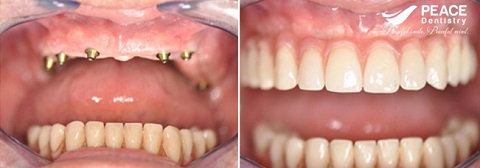trồng răng implant nguyên hàm all on 6