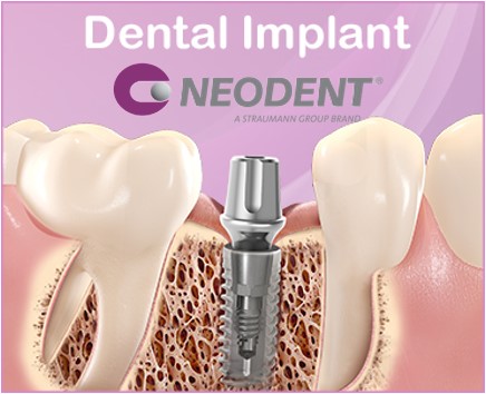 Trụ Implant Neodent Straumann: Tích hợp vượt trội - thách thức thời gian