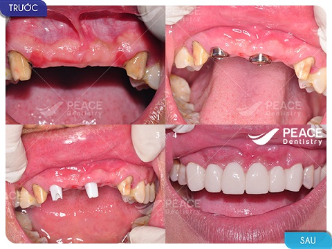 trồng răng implant thay thế cho răng sứ bắc cầu