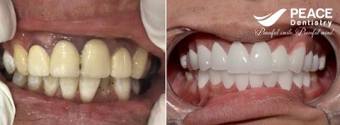 bọc răng sứ không làm hạn chế sức nhai
