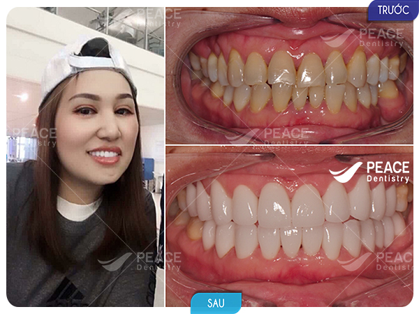 hình ảnh khách hàng bọc răng sứ 3
