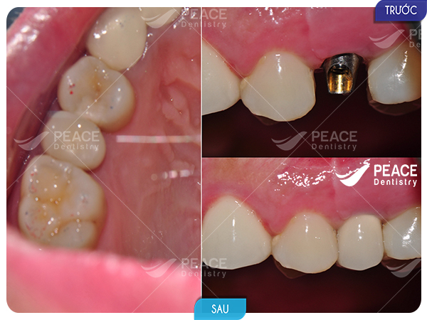 hình ảnh khách hàng implant ít răng 1