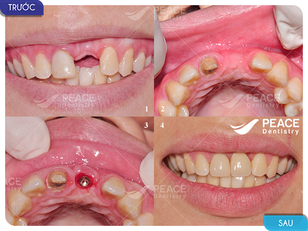 hình ảnh khách hàng implant ít răng 2