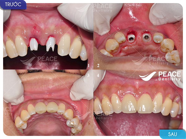 hình ảnh khách hàng implant ít răng 3
