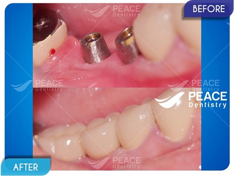 trụ implant tích hợp chắc chắn vào xương hàm