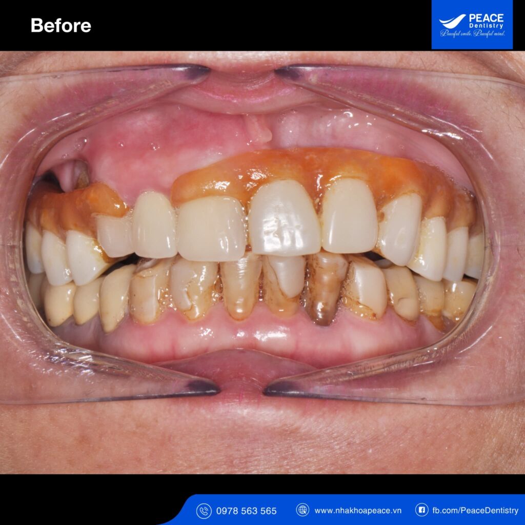 case trồng răng implant all on 5 cho người bị tiểu đường