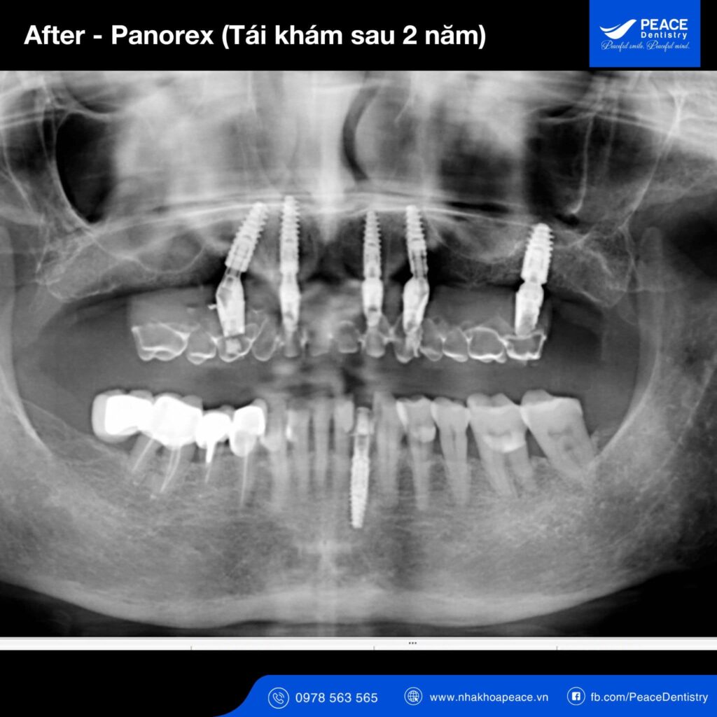 case trồng răng implant all on 5 cho người bị tiểu đường