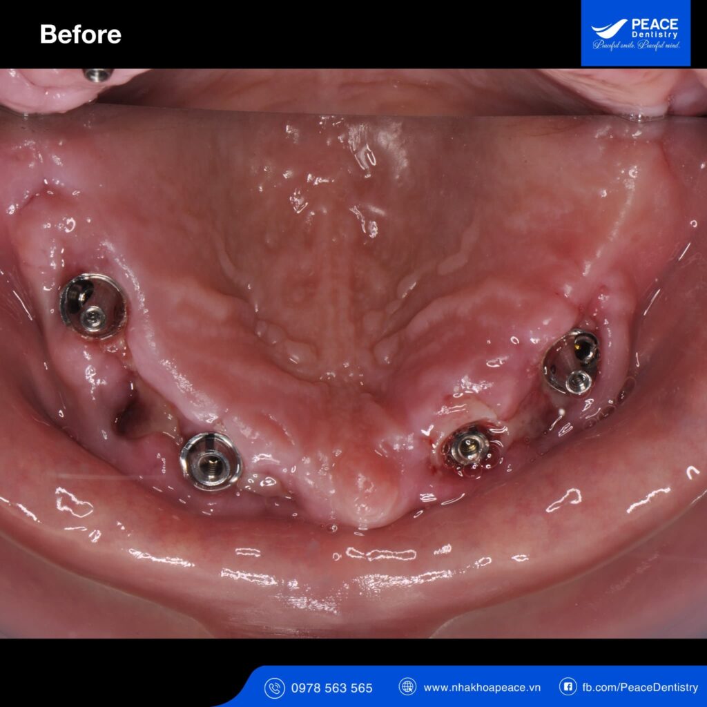 case trồng răng implant all on 5 cho người bị tiểu đường