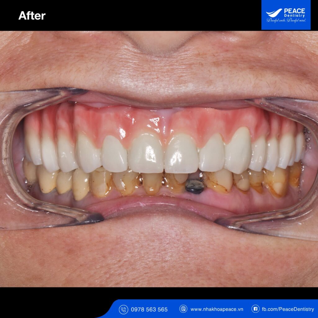 case trồng răng implant all on 5 cho người bị tiểu đường
