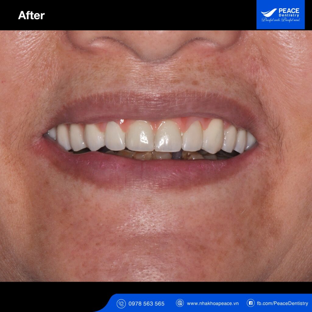 case trồng răng implant all on 5 cho người bị tiểu đường