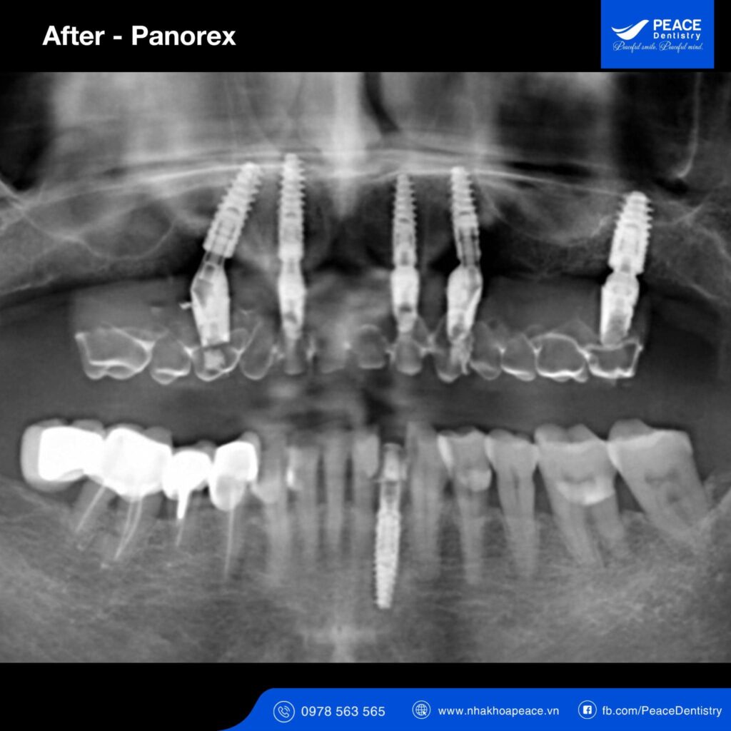 case trồng răng implant all on 5 cho người bị tiểu đường
