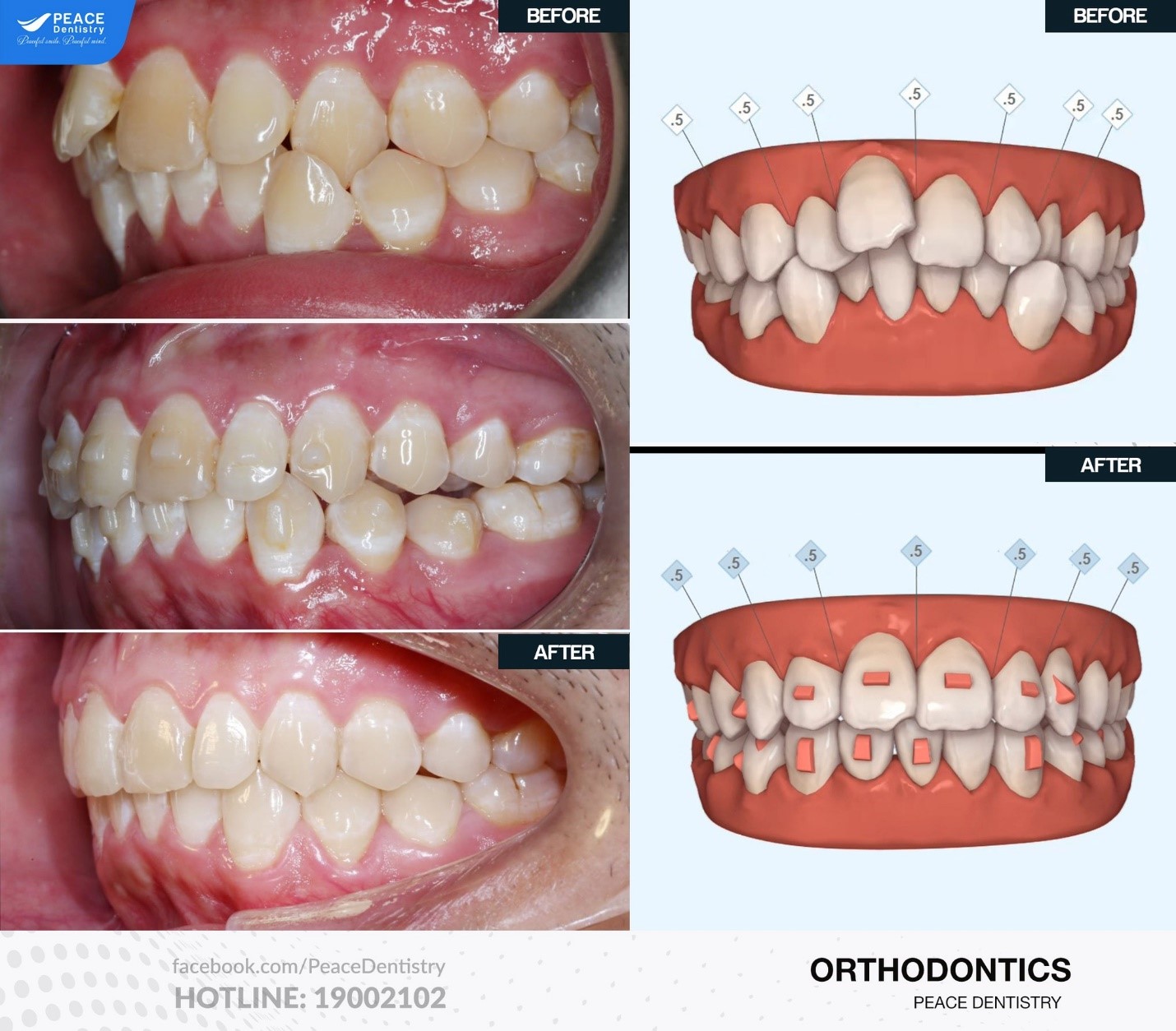 hình ảnh niềng răng hô bằng invisalign hoàn thành sau 16 tháng
