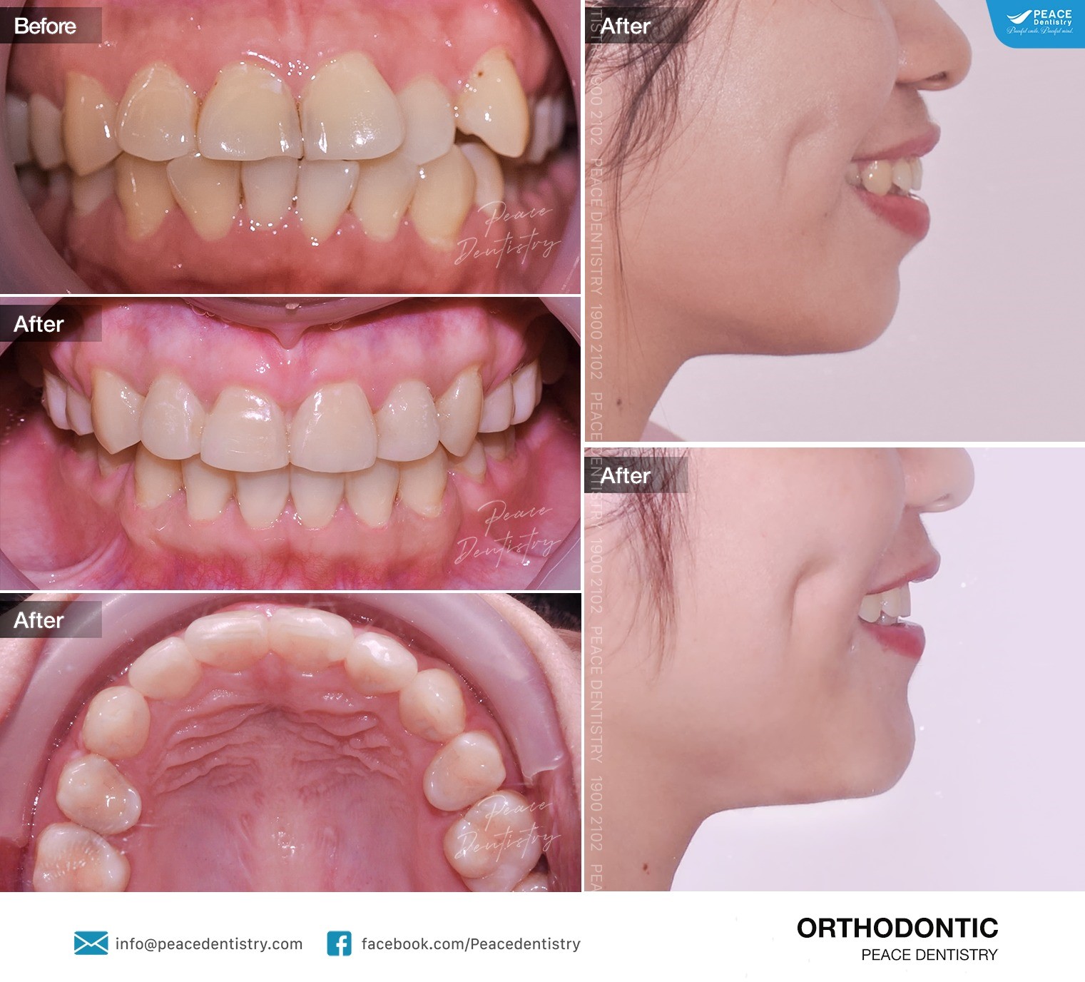 niềng răng hô hoàn thành sau 24 tháng