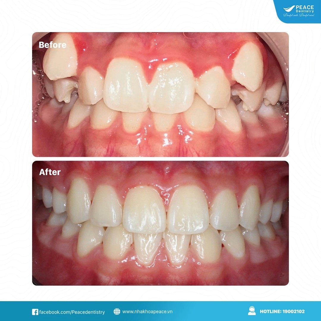 niềng răng khớp cắn sâu với mắc cài tự đóng hoàn thành sau 23 tháng