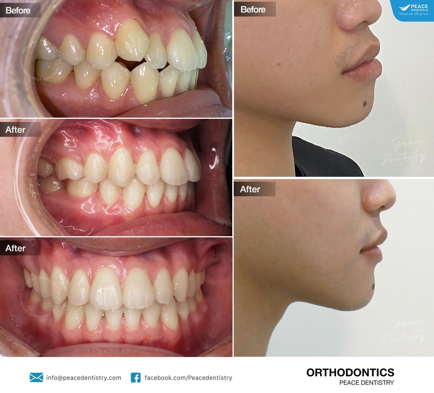 hình ảnh niềng răng trong suốt hoàn thành sau 30 tháng