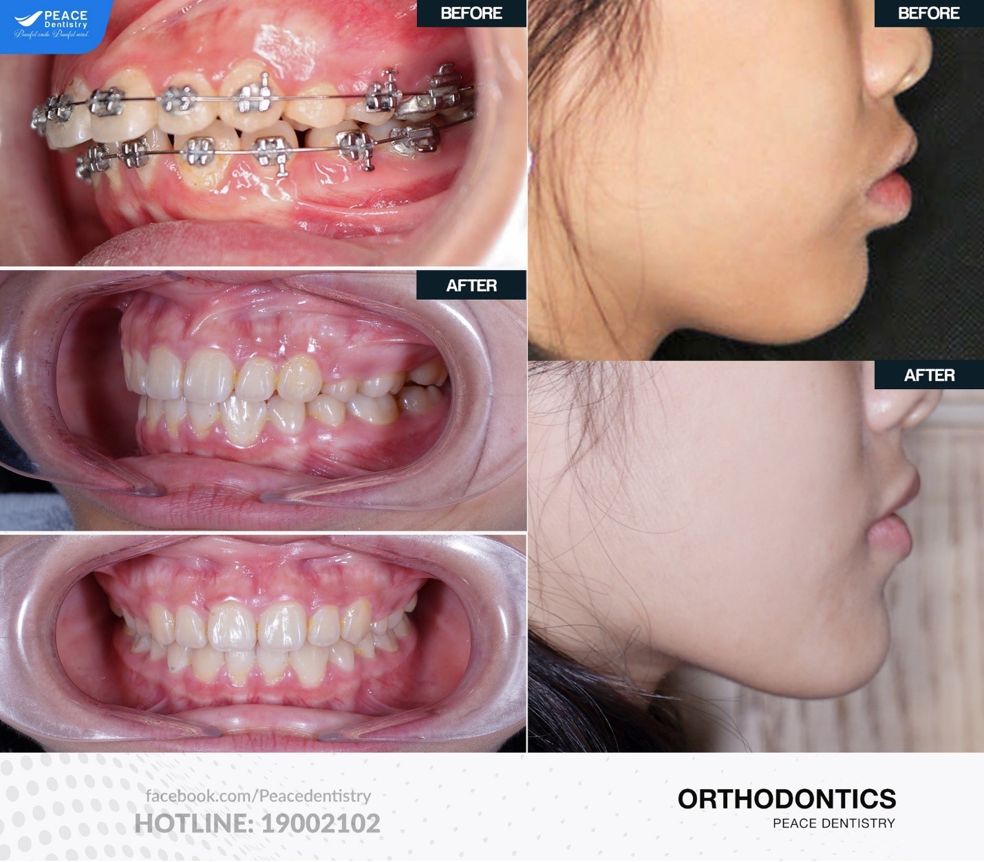 kết quả niềng răng hô sau 24 tháng