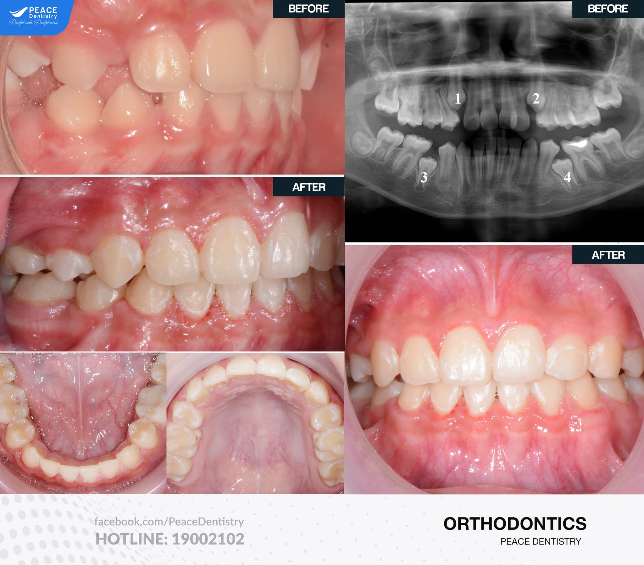 niềng răng mọc ngầm cho trẻ em