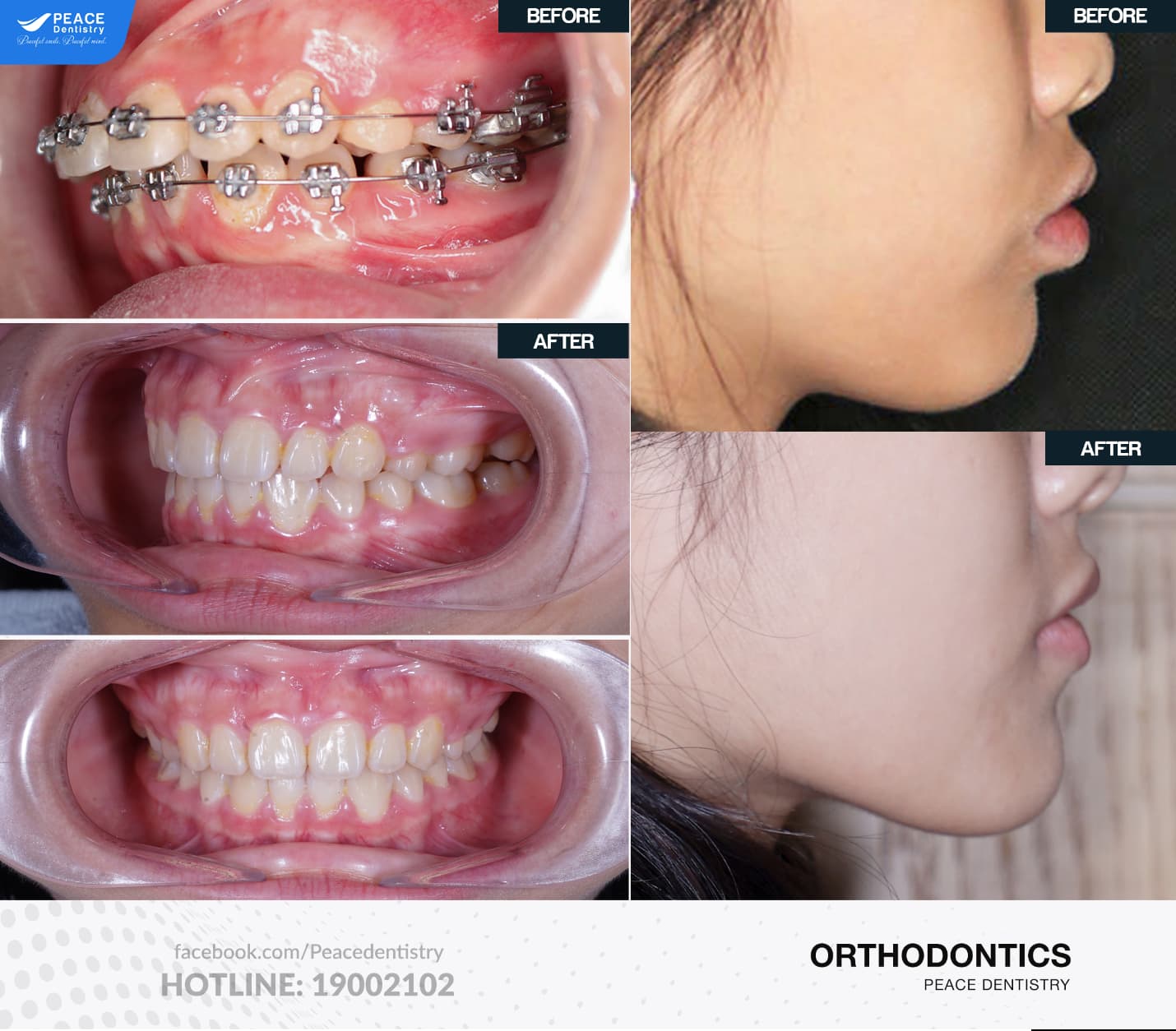 niềng răng quận 7