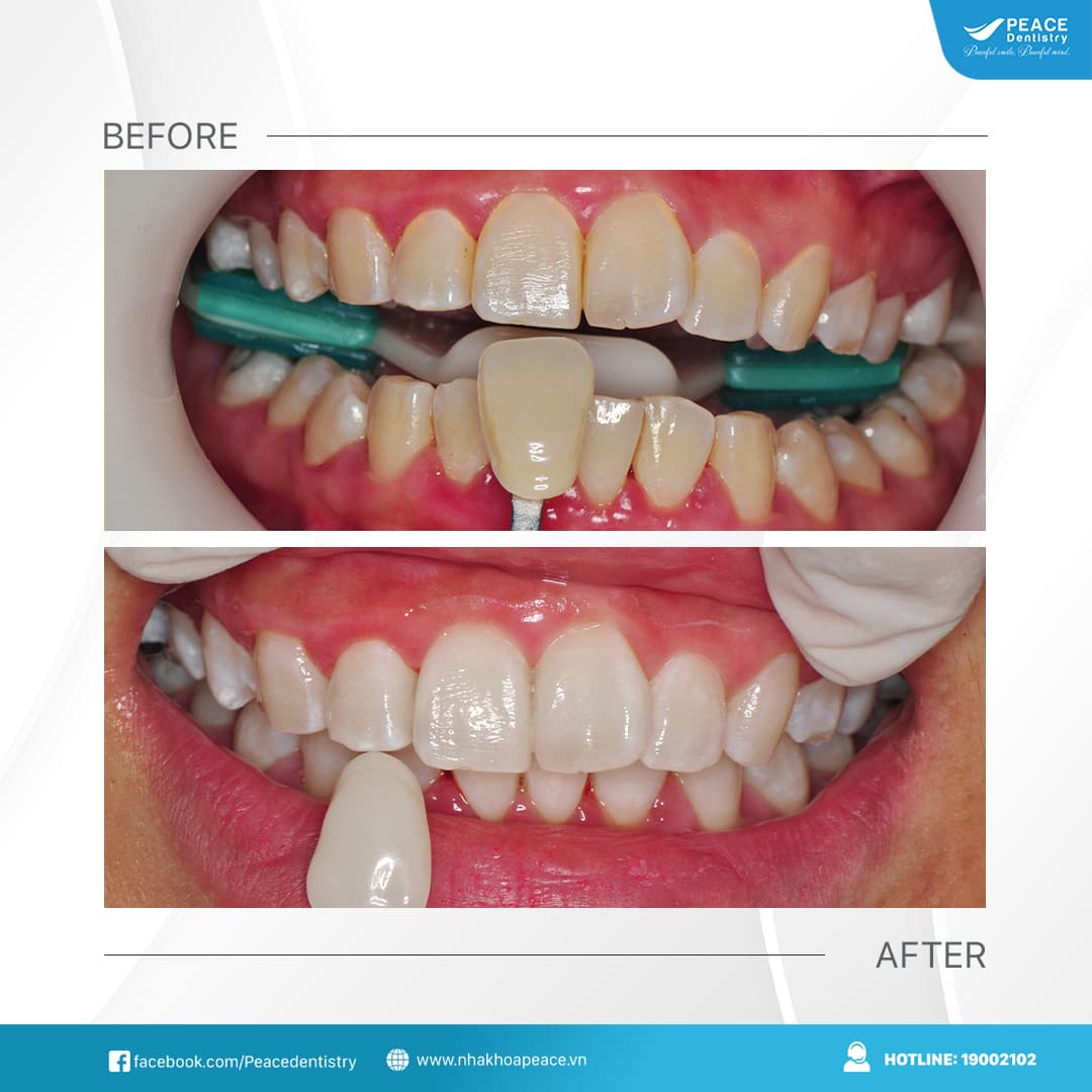 tẩy trắng răng tại peace dentistry quận 7