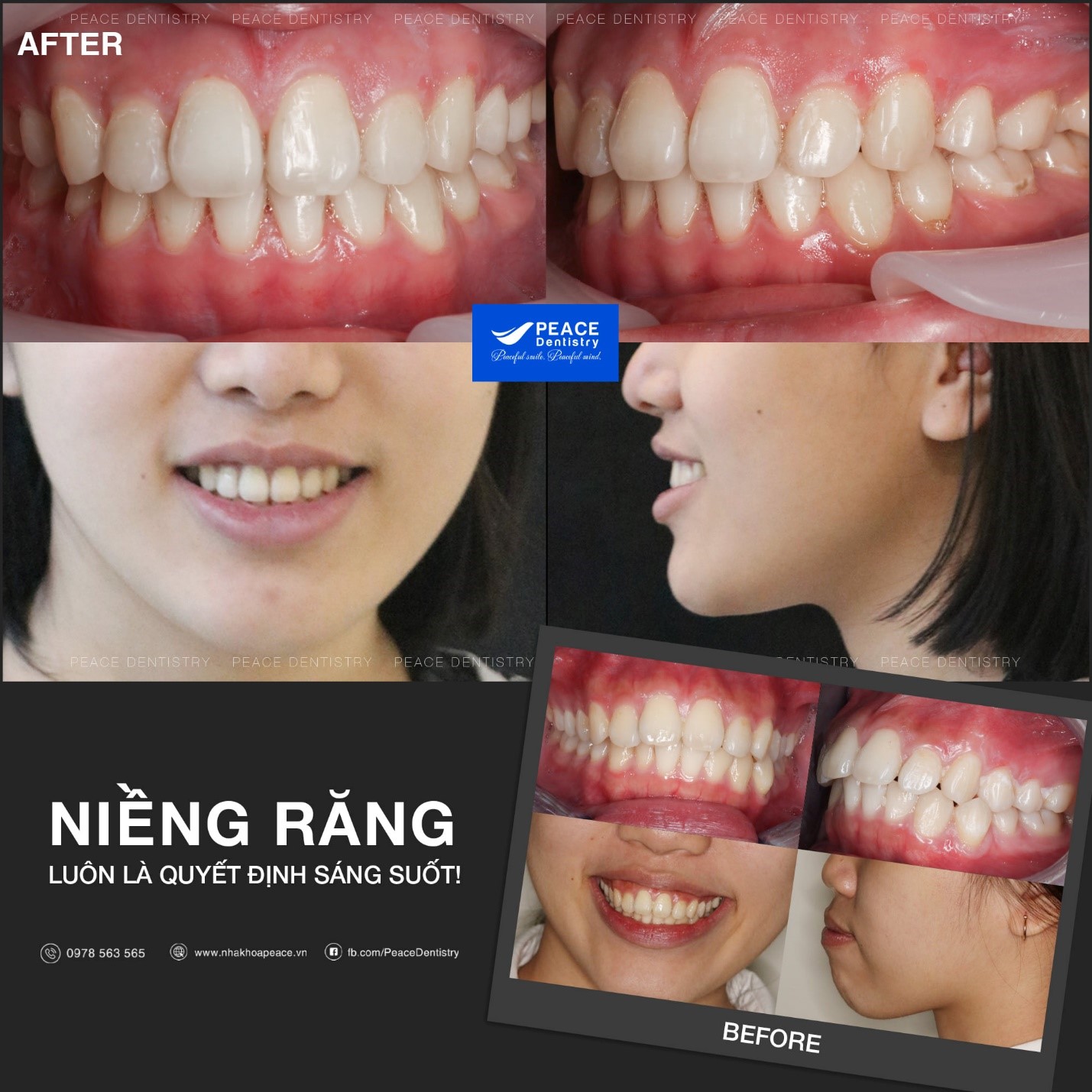 thời gian niềng răng hô mất bao lâu