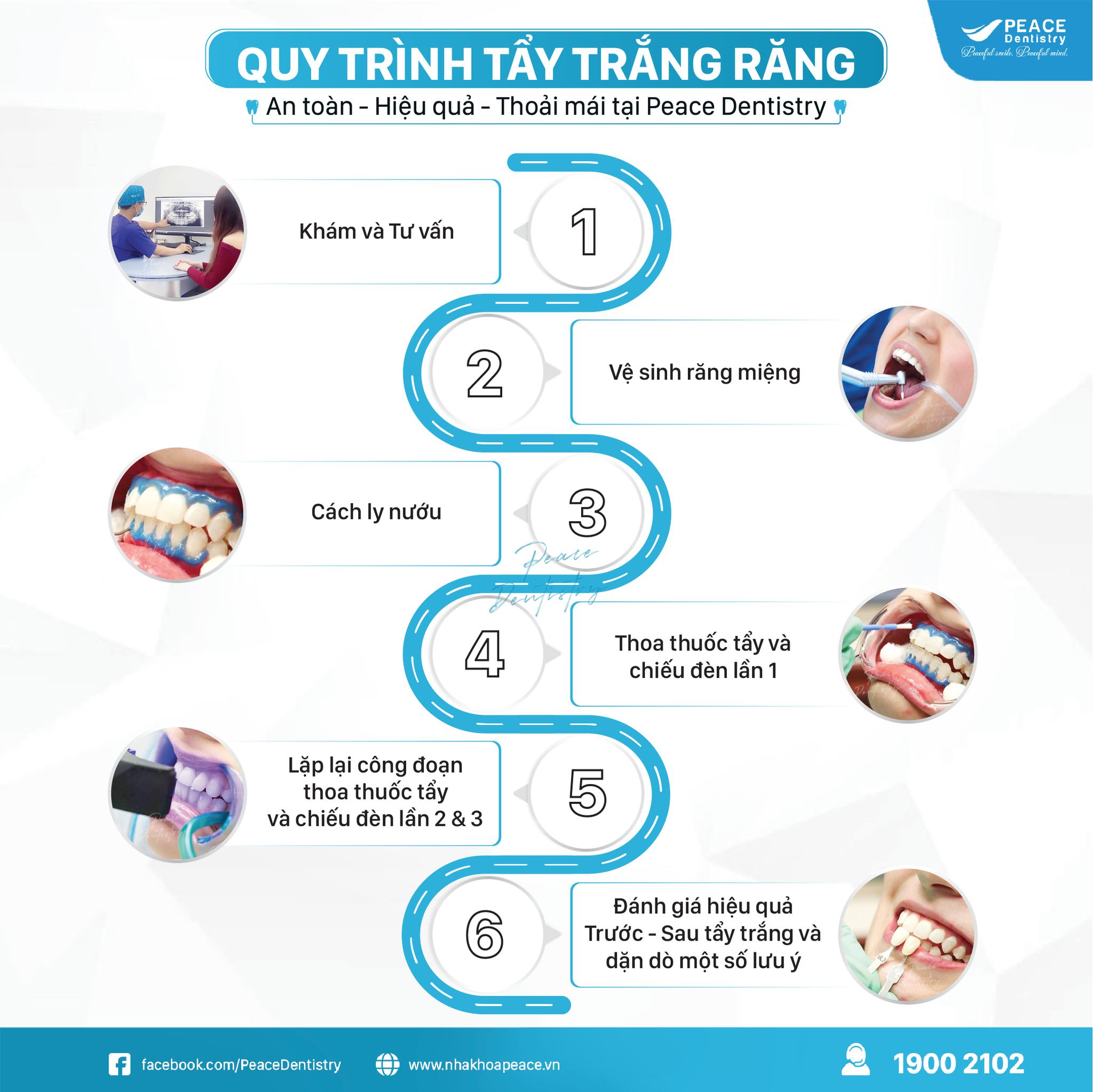 quy trình tẩy trắng răng