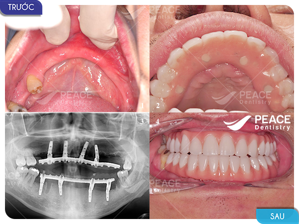 trồng răng implant all on 4 cho trường hợp mất răng